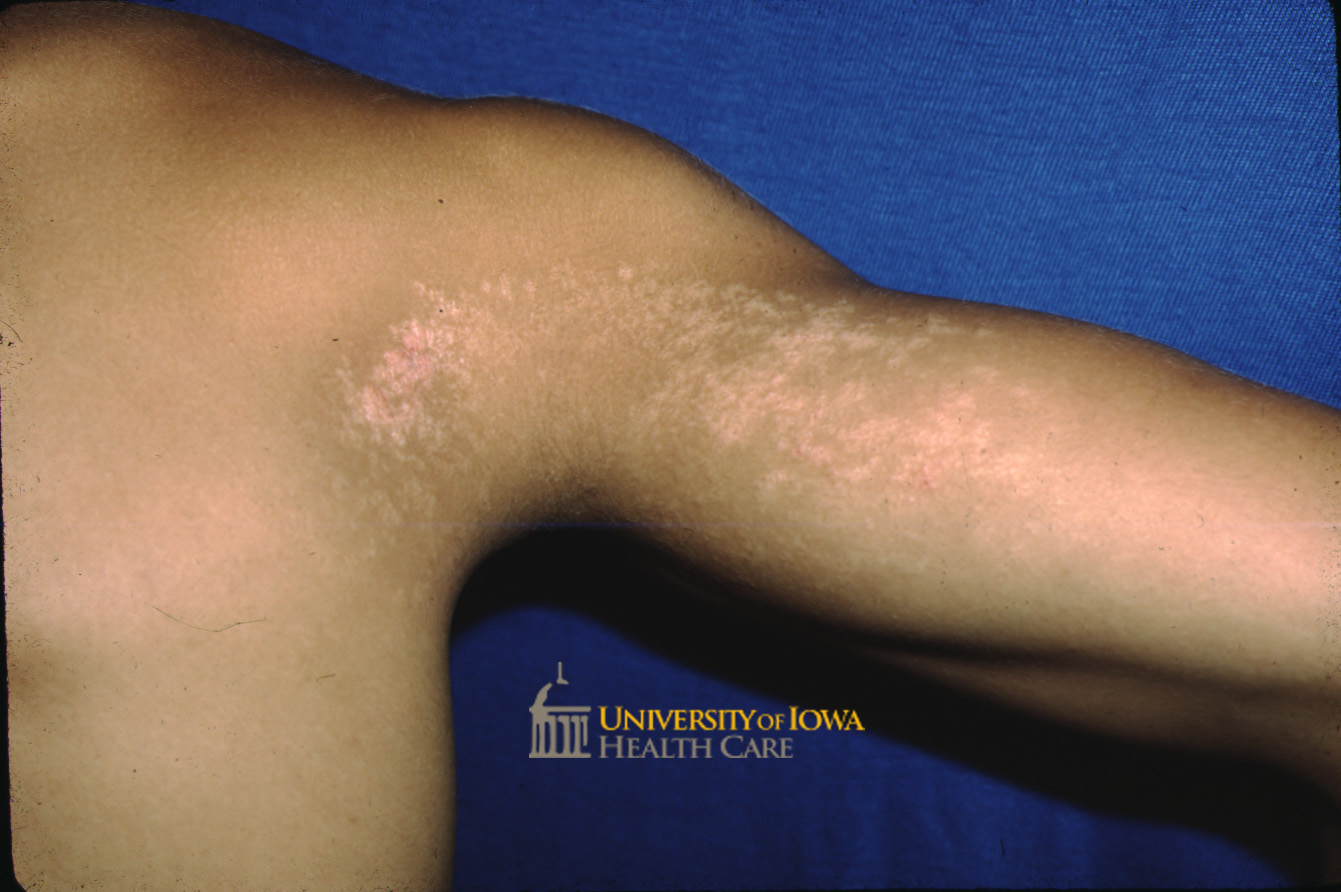 Curvilineal hypopigmented papules coalescing forming a plaque on the medial upper arm. (click images for higher resolution).